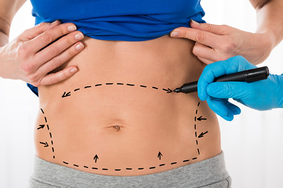 Cirugia estetica del abdomen con miniabdominiplastia