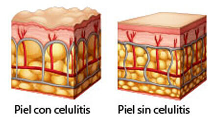celulitis lipoescultura